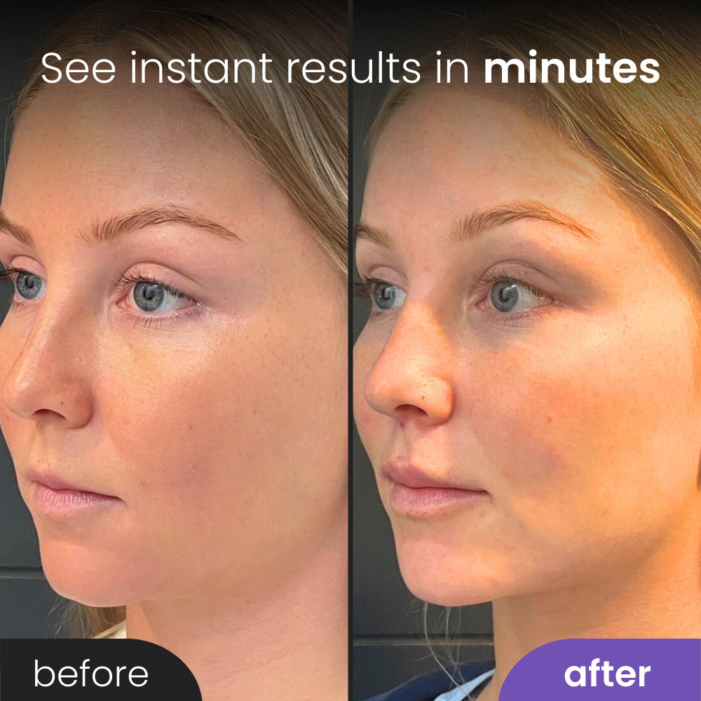 UpLift™ Beauty Sculptor
